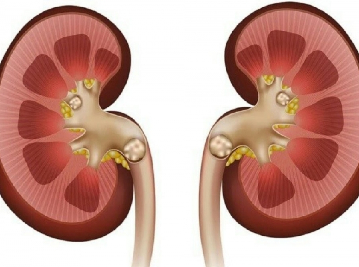 سنگ کلیه و سنگ شکن های گیاهی 